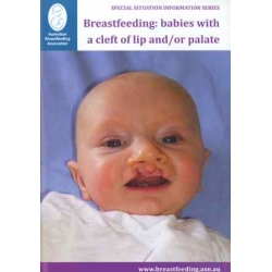 Breastfeeding: Babies with Cleft Lip and/or Cleft Palate